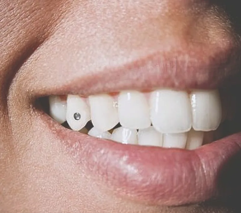 Estētiskā zobārstniecība — zobu balināšana