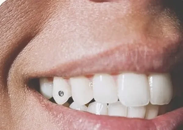 Zobu kristāli — formas kristāli uz zobiem