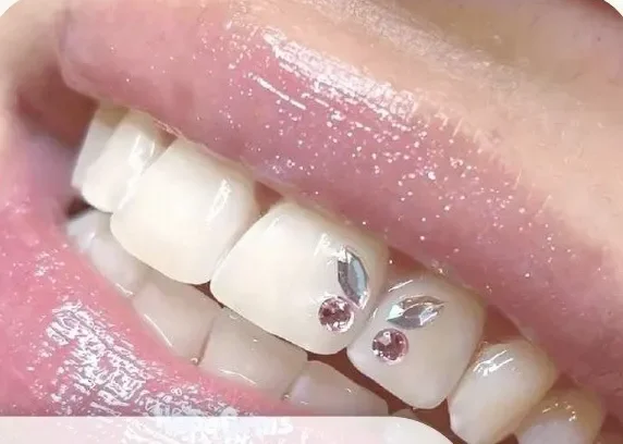 Zobu kristāli — viens klasiskais kristāls uz zoba